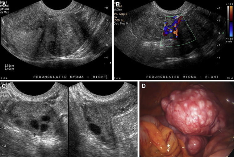 Miyom çikolata kisti nedir?