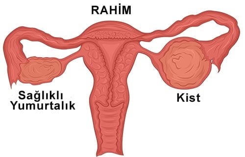 yumurtalık kistleri