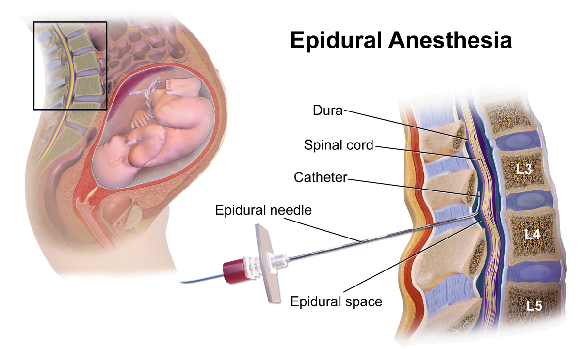 epidural doğum