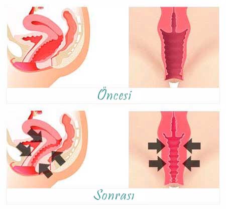 vajinal daraltma ameliyatı nasıl yapılır