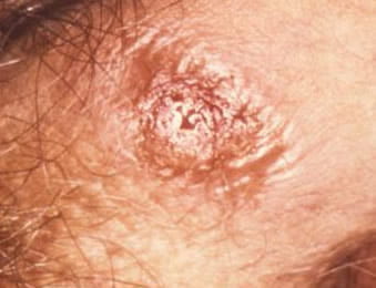 birincil sifiliz genital bölge görünümü