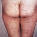 frengi bulaşan kadında cilt döküntüsü görüntüsü