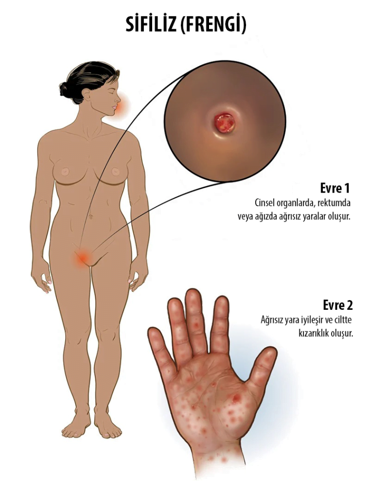 Sifiliz belirtileri