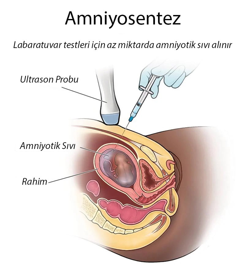 Amniyosentez testi nasıl yapılır