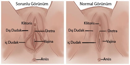 labioplasti ameliyatı öncesi ve sonrası