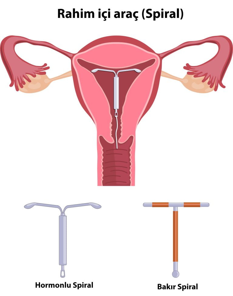 rahim içi araç, spiral taktırma